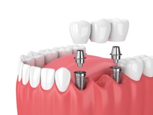 implant